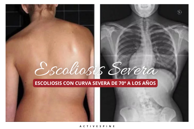 Escoliosis severa
